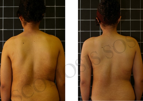 Scoliosis Before & After Treatment