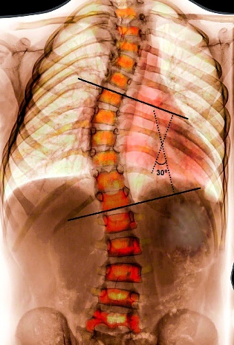 How is Scoliosis Measured?
