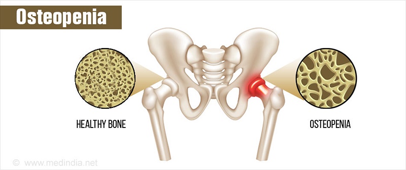 Osteopenia Bones