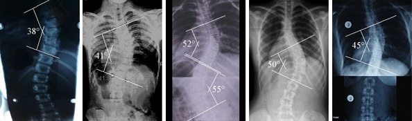 Scoliosis X-Rays