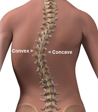 Convex and Concave Scoliosis Curve