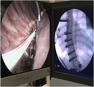 Spinal Tethering Operation