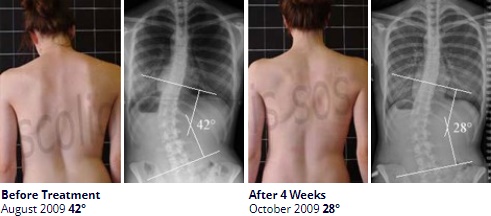 Can Scoliosis Be Reversed