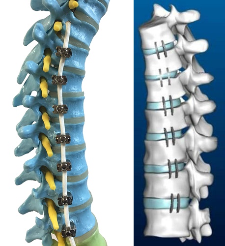 Spinal Tethering & Stapling
