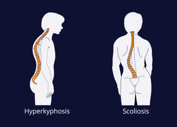 Kyphosis vs scoliosis