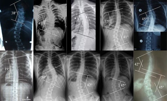X-rays of people with scoliosis