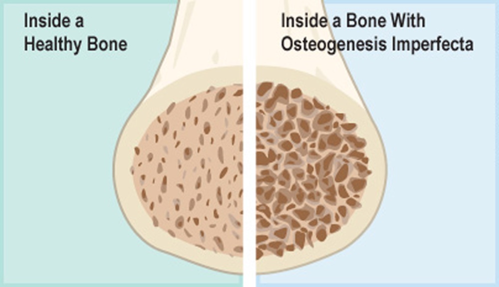 Osteogenesis imperfecta